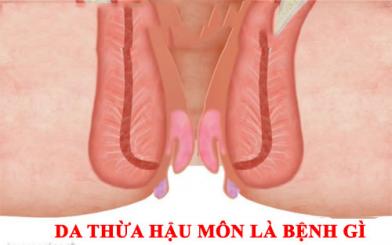 Da thừa hậu môn cảnh báo bệnh lý nguy hiểm nào?