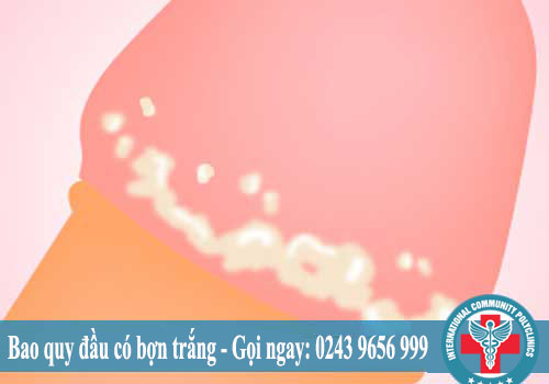 Bao quy đầu có màu trắng