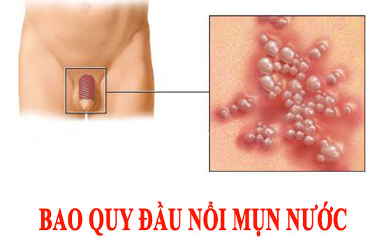 Bao quy dầu nổi mụn nước