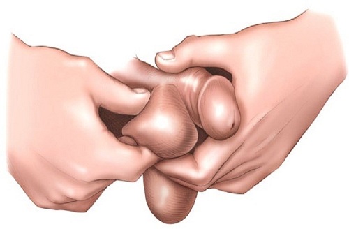 Bệnh cà sa ở nam giới