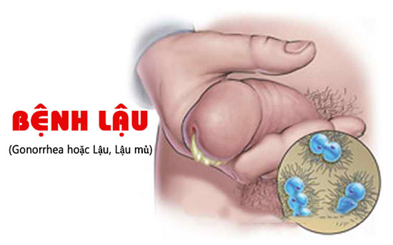 Bệnh lậu