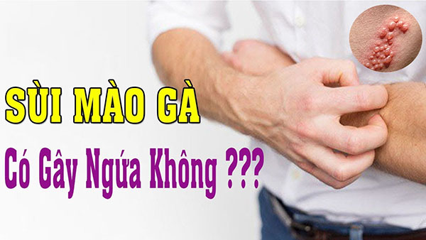 Sùi mào gà có gây ngứa không