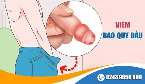 Bệnh viêm bao quy đầu