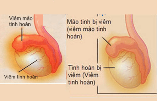 Bệnh viêm mào tinh hoàn
