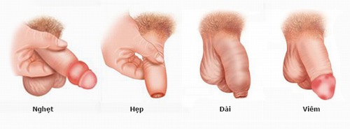 Các dạng bao quy đầu