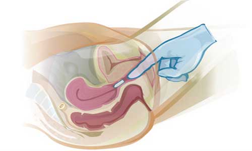 Cách đặt thuốc âm đạo đúng cách