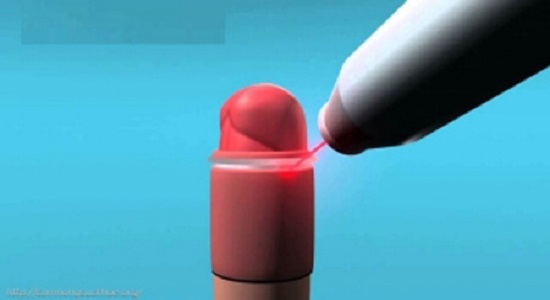 Cắt bao quy đầu bằng laser
