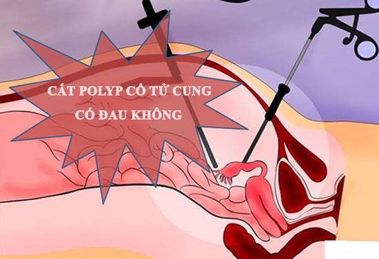 Cắt polyp cổ tử cung có đau không