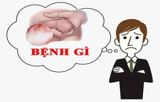 Chảy mủ ở bộ phận sinh dục nam