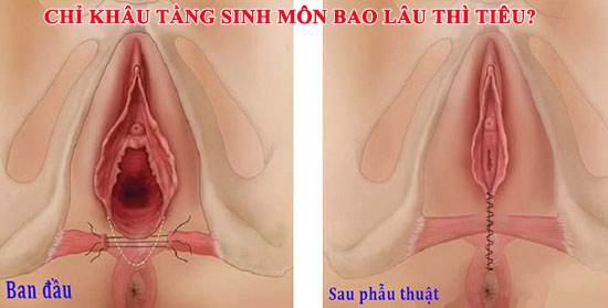 Chỉ khâu tầng sinh môn bao lâu thì tiêu?