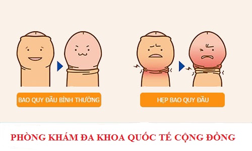 Chữa hẹp bao quy đầu tại Đa Khoa Quốc Tế Cộng Đồng