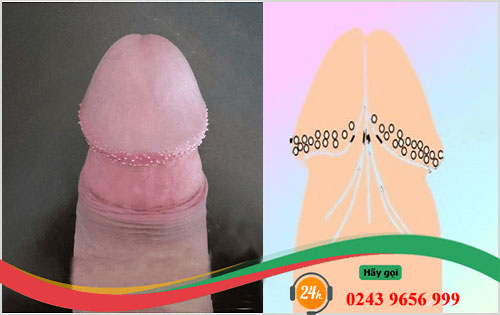 Chuỗi hạt ngọc dương vật