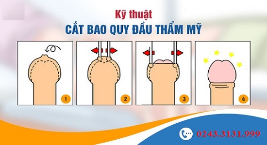 Cắt bao quy đầu thẩm mỹ Hàn Quốc