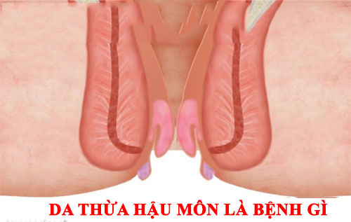Da thừa hậu môn