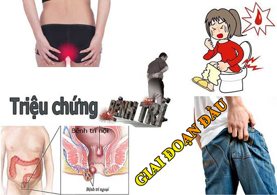 Dấu hiệu bệnh trĩ giai đoạn đầu
