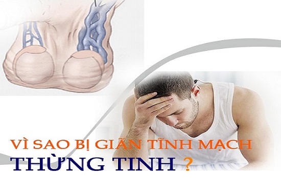 Giãn mạch thừng tinh