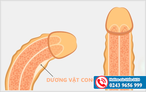Dương vật bị cong