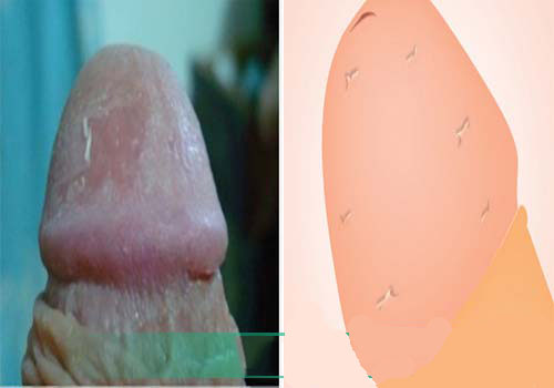 Dương vật bị tróc da