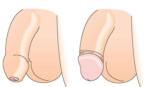 Hẹp bao quy đầu ở người lớn là gì