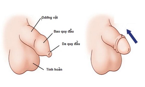 Hẹp bao quy đầu ở trẻ em