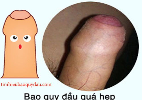 Hẹp bao quy đầu phải làm sao