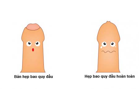 Hẹp bao quy đầu