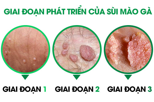 Các giai đoạn phát sừi mào gà