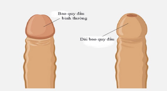 Dài bao quy đầu