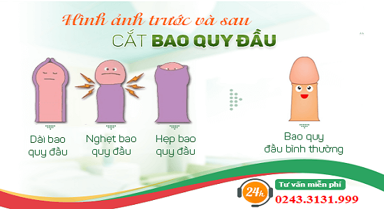 Hình ảnh trước và sau cắt bao quy đầu