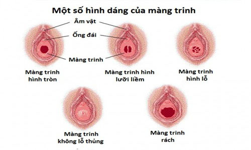 Màng trinh ở phụ nữ