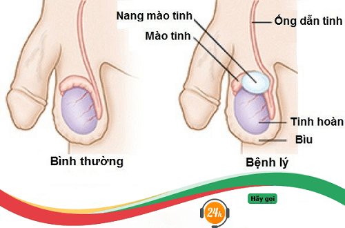 Nang mào tinh hoàn