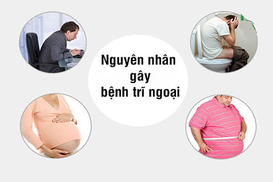 Nguyên nhân gây bệnh trĩ ngoại