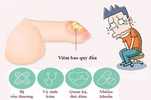 Nguyên nhân gây viêm bao quy đầu