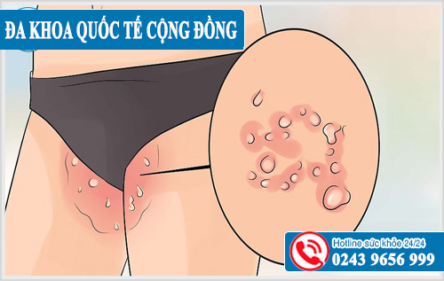 Nổi mụn ở vùng kín nam