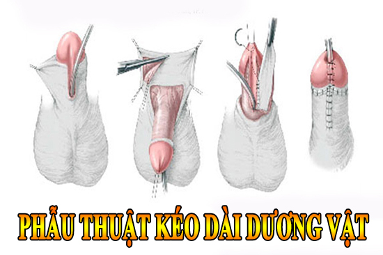 Phẫu thuật kéo dài dương vật