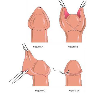 Phương pháp điều trị hẹp bao quy đầu