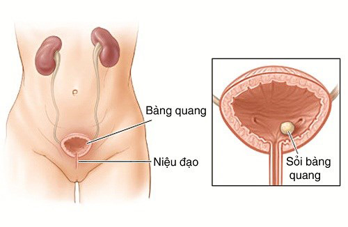 Sỏi bàng quang