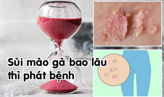 Sùi mào gà bao lâu thì phát bệnh