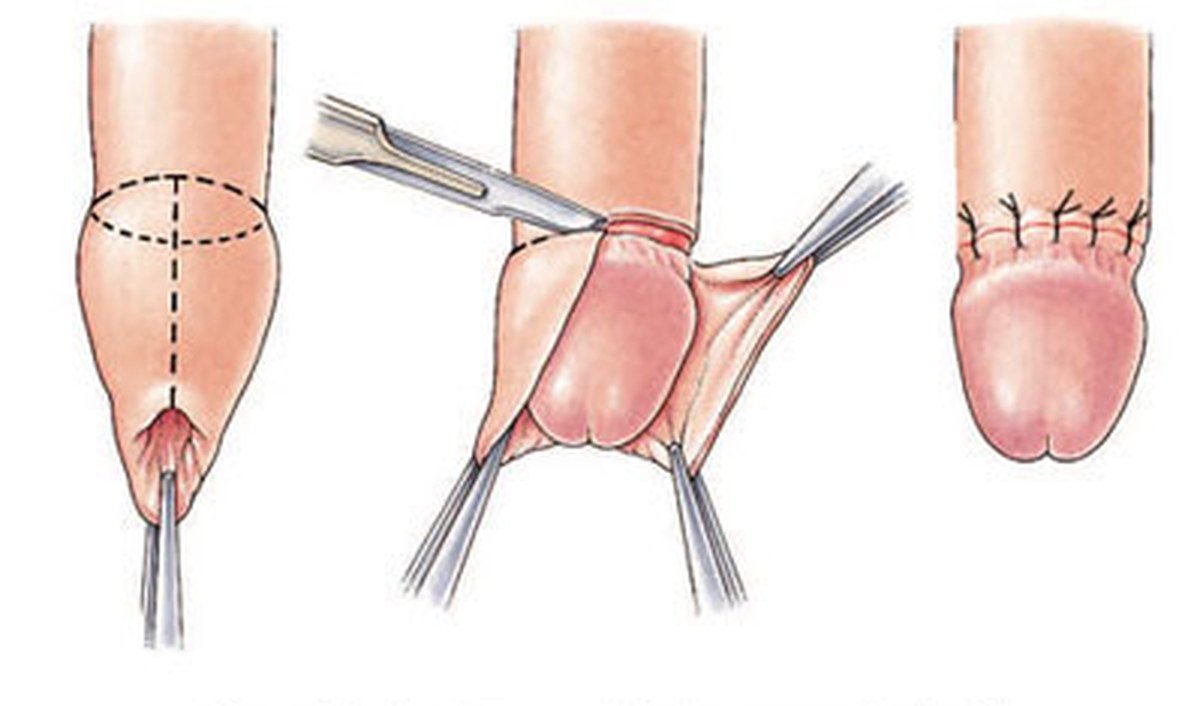 Điều trị nghẹt bao quy đầu