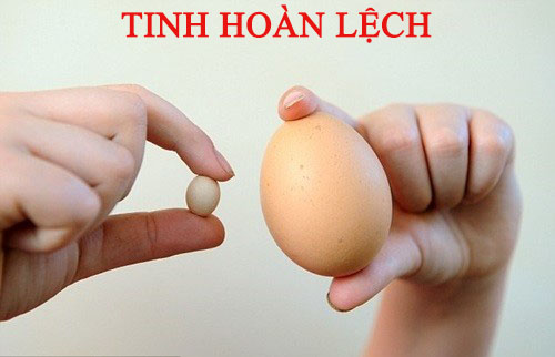 Tinh hoàn bên to bên nhỏ ở trẻ sơ sinh