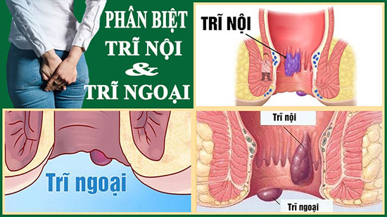 Trĩ nội trĩ ngoại khác nhau như thế nào