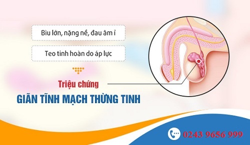 Triệu chứng giãn mạch thừng tinh
