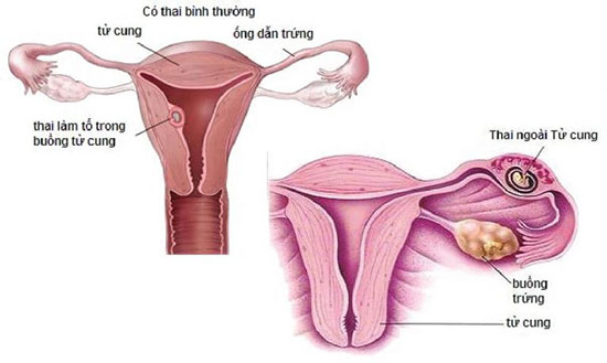 triệu chứng tắc vòi trứng