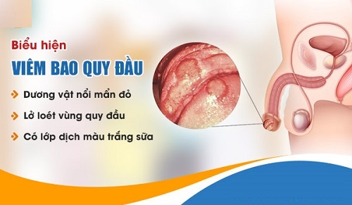 Triệu chứng bao quy đầu