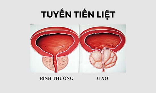 U xơ tiền liệt tuyến