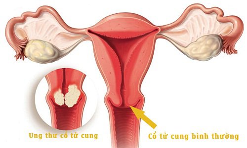 Khám ung thư cổ tử cung ở đâu uy tín