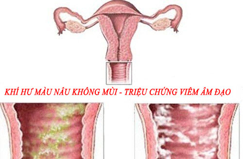 Viêm âm đạo - khí hư màu nâu không mùi