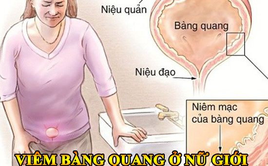 Viêm bàng quang ở nữ giới