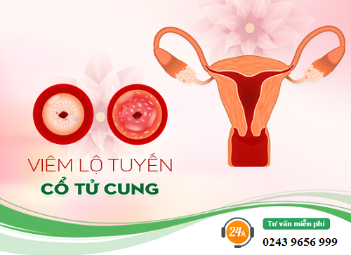 Viêm lộ tuyến cổ tử cung