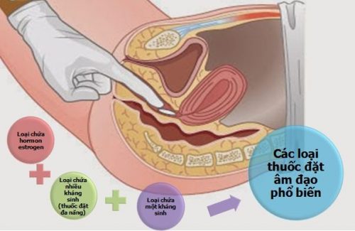 Các loại viên đặt phụ khoa